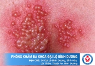 Xuất hiện mụn ở môi lớn, môi bé vùng kín là bị gì