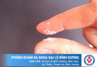 Khí hư trắng đục như bột, không mùi hoặc có mùi hôi tanh là bị gì