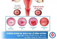 Viêm lộ tuyến độ 2 có nguy hiểm không
