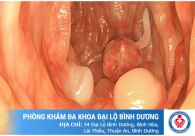 Những phương pháp điều trị Polyp cổ tử cung hiệu quả hiện nay