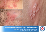 Vùng kín nổi mụn nước bị ngứa phải làm sao?