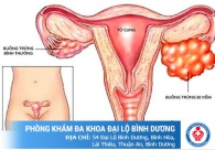 Viêm buồng trứng và những điều chị em cần biết
