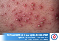Nổi mụn đốm trắng, hạt trắng ở vùng kín gây ngứa là do đâu? Cách điều trị hiệu quả