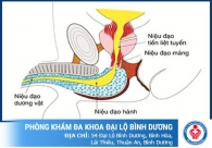 Bị sưng đau lỗ niệu đạo - Cẩn thận bệnh viêm niệu đạo tấn công