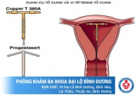 Địa chỉ tháo vòng tránh thai an toàn ở Bình Dương