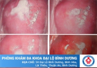 Viêm âm đạo - Căn bệnh phổ biến nhất ở phái nữ