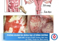 Bệnh nấm phụ khoa - dấu hiệu nhận biết và cách điều trị hiệu quả