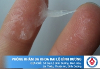 Cách điều trị bệnh khí hư hiệu quả