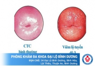 Tư vấn về bệnh viêm lộ tuyến cổ tử cung