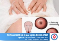 Viêm lộ tuyến điều trị như thế nào tốt