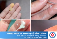 Điều trị bệnh huyết trắng ở nữ giới thế nào hiệu quả
