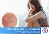 Vì sao cô bé bị nổi mụn