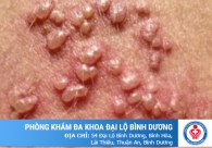 Viêm nhiễm vùng kín nữ giới là như thế nào?