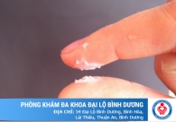 Khí hư vón cục như bã đậu