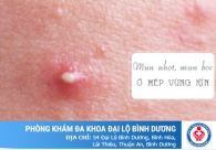 Nổi mụn nhọt sưng to ở mép vùng kín thì phải làm sao