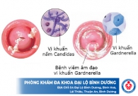 Hình ảnh viêm phụ khoa ở nữ