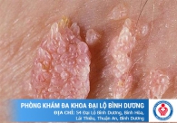 Nổi mụn thịt ở vùng kín nữ là bệnh gì