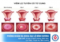 Viêm lộ tuyến độ 3 và mức độ nguy hiểm khó lường