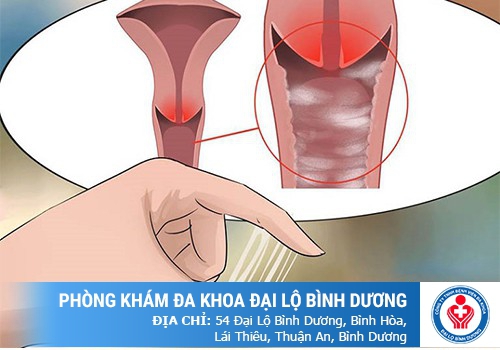 Đa nang buồng trứng